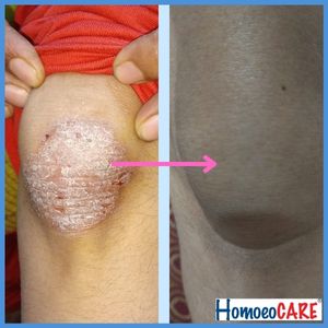 Homeopathic treatment for Psoriasis Knees